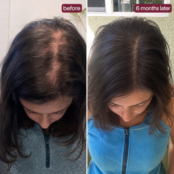 HAILEY A. before and after